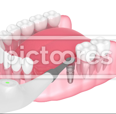 smart implant detector helping to locate buried healing cap