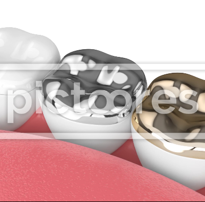 Different types of dental onlay filling