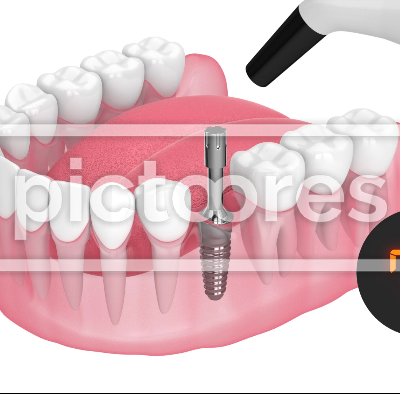 Monitoring device for osseointegration allows for precise assessment of dental implant stability.