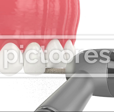 Upper jaw with dental veneer placement