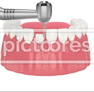 dental veneers placement procedure