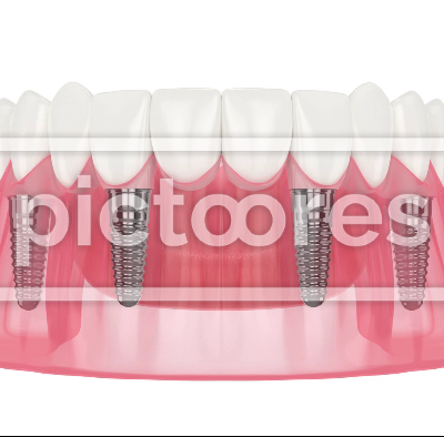 Mandibular prosthesis all-on-4 system supported by implants