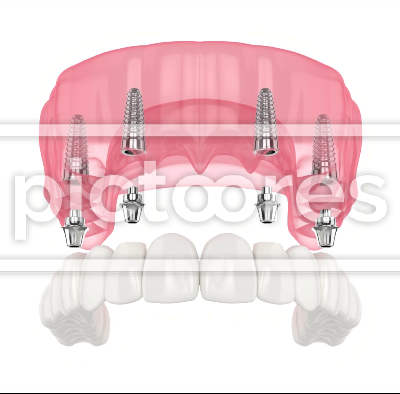 Mandibular prosthesis all on 4system supported by implants