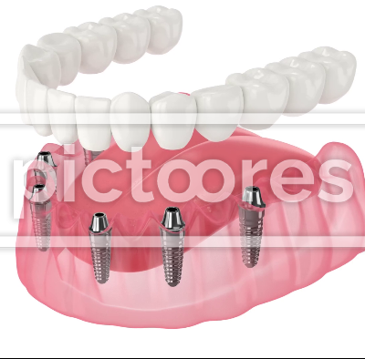Mandibular prosthesis all on 6 system supported by implants