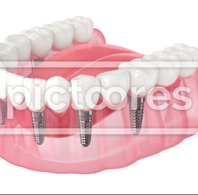 Mandibular prosthesis all-on-6 system supported by implants
