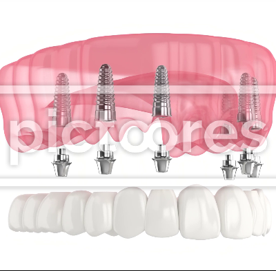 prosthesis all-on-6 system supported by implants