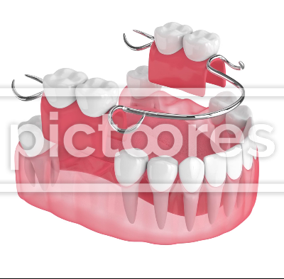 Removable partial denture