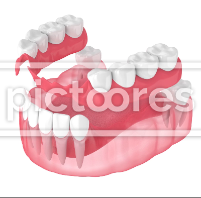 Jaw with removable partial denture