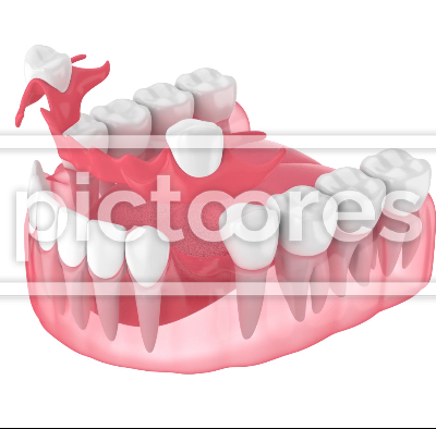 Jaw with removable partial denture