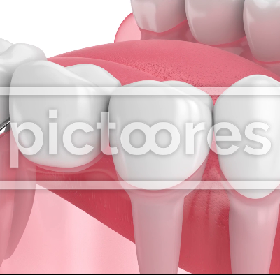 Jaw with removable partial denture