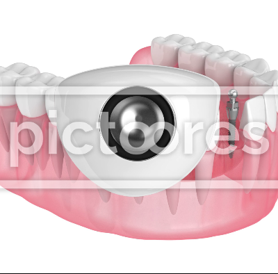 Mini dental implant placement