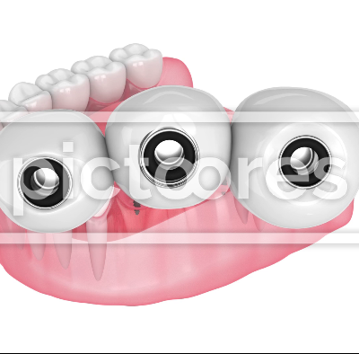 Dental bridge supported by mini dental implants