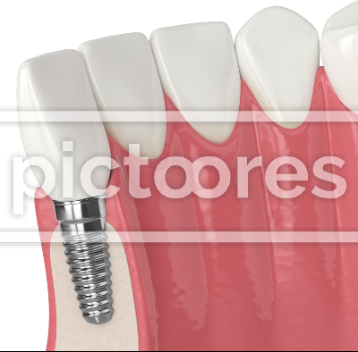 Lower jaw with dental implant installation