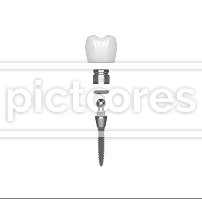 Mini dental implant installation