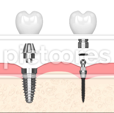 Comparison of two types dental implants