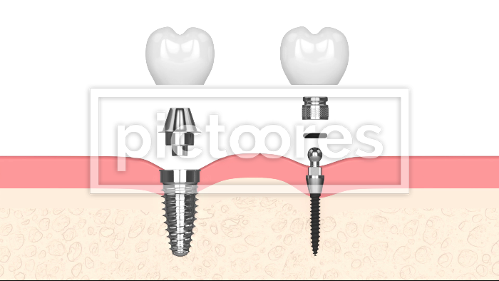 Comparison Of Two Types Dental Implants