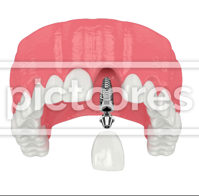 Upper jaw with dental implant installation