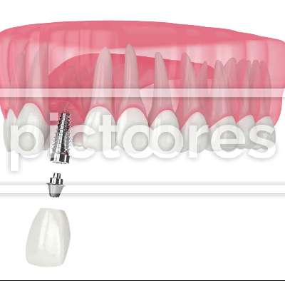 dental implant