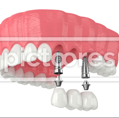 Upper jaw with implants supporting dental bridge