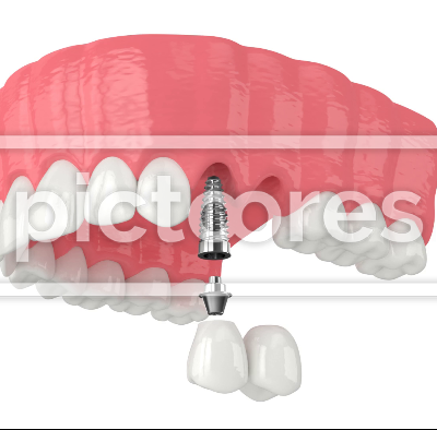 Upper jaw with implant supported dental cantilever bridge