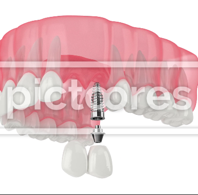Upper jaw with implant supported dental cantilever bridge