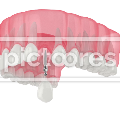 Upper jaw with dental mini implant