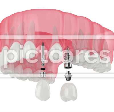 Upper jaw with two types of dental implants