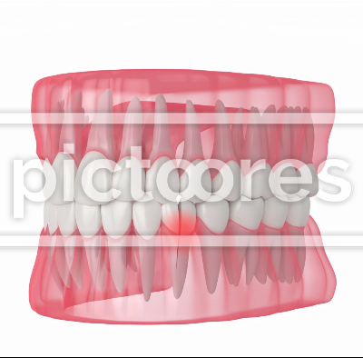Human jaw with cracked tooth