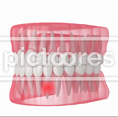 Human jaw with cracked and aching tooth