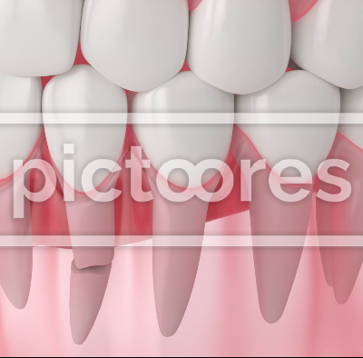 Human jaw with cracking tooth