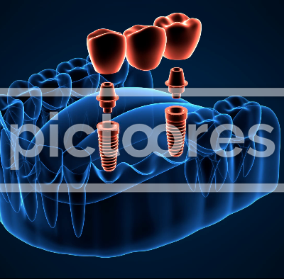 Jaw with implants supporting dental bridge