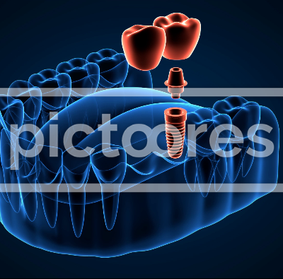 Jaw with implant supported dental cantilever bridge