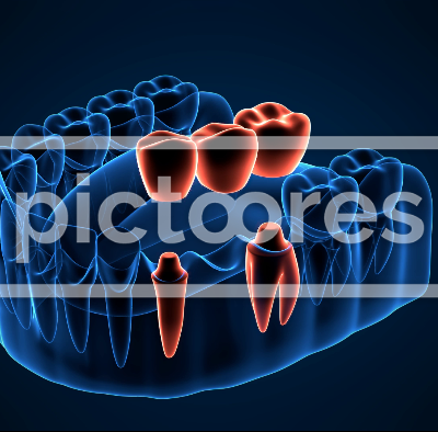 Jaw with dental bridge supported by molar and premolar teeth on dark blue background