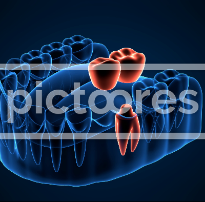 Jaw with dental cantilever bridge placement on dark blue background