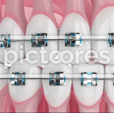 Teeth alignment by orthodontic braces