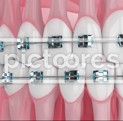 Teeth alignment by orthodontic metal braces