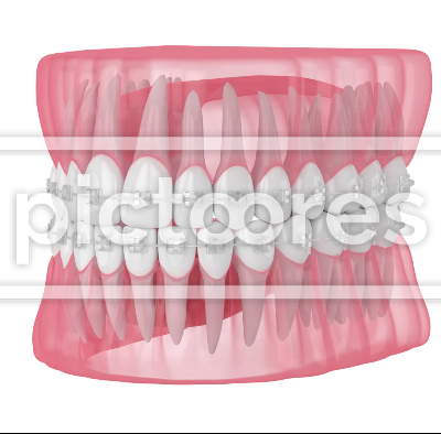 Teeth alignment by orthodontic clear ceramic braces