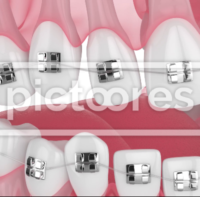 Orthodontic treatment with metal braces