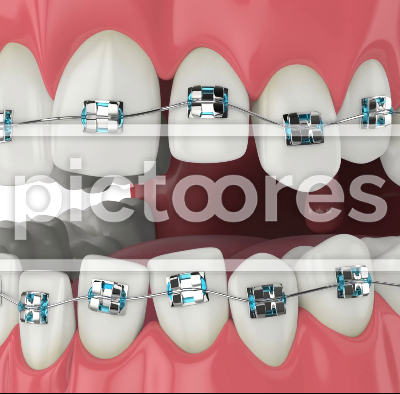 Teeth alignment by orthodontic metal braces
