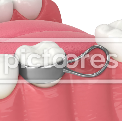 Tooth extraction, space maintainer and new tooth growth process