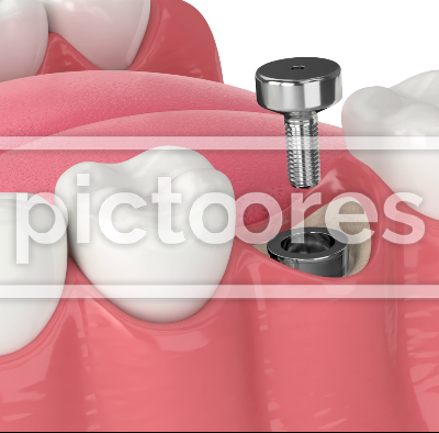Dental implant installation procedure