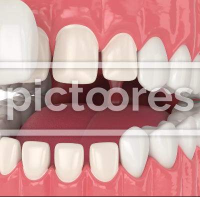Human jaw with dental veneers installation