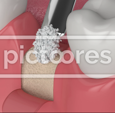 Dental bone grafting and bone augmentation procedure