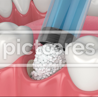 Dental bone grafting and bone augmentation procedure