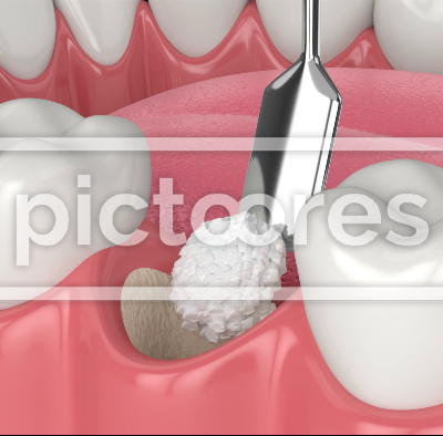 Dental bone grafting and bone augmentation procedure