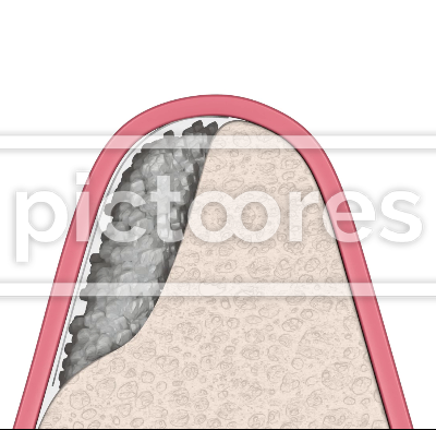 Dental bone grafting as preparation for dental implant installation