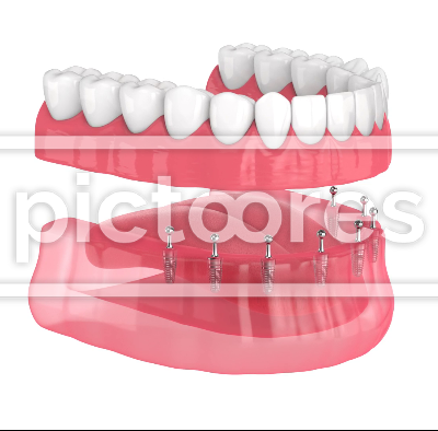 All-on-8 removable supported by implants overdenture