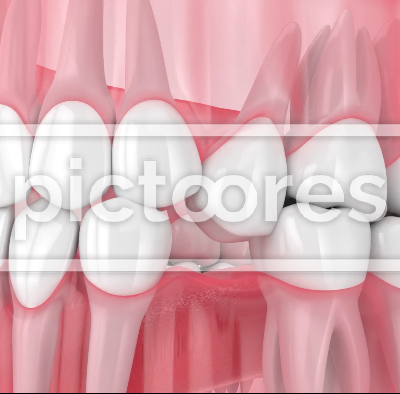 Teeth sliding towards the area of missing tooth