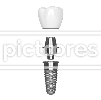 Dental implant installation