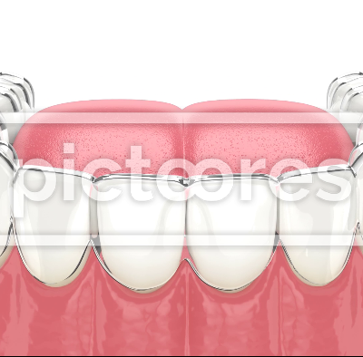 Clear orthodontic aligner